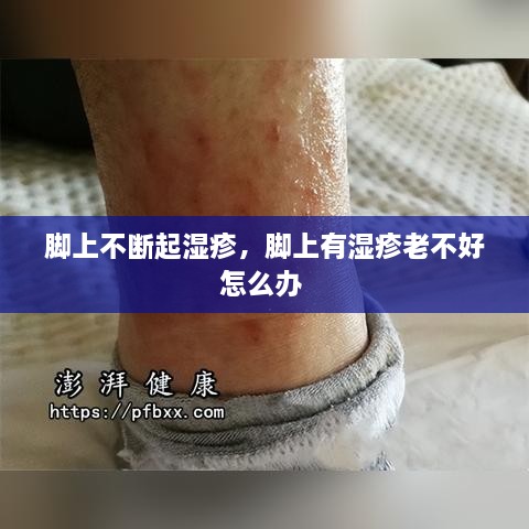 腳上不斷起濕疹，腳上有濕疹老不好怎么辦 