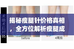 揭秘瘦腿針價格真相，全方位解析瘦腿成本！