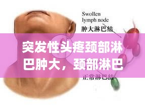 突發(fā)性頭疼頸部淋巴腫大，頸部淋巴結(jié)疼頭疼 