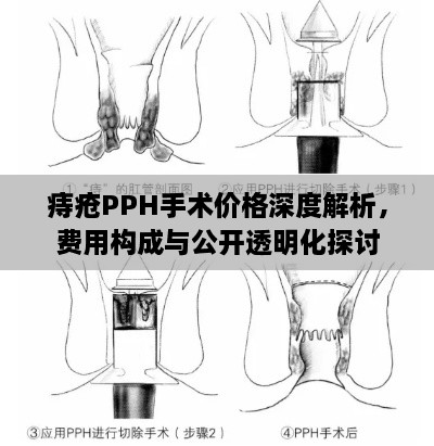 痔瘡PPH手術(shù)價(jià)格深度解析，費(fèi)用構(gòu)成與公開透明化探討
