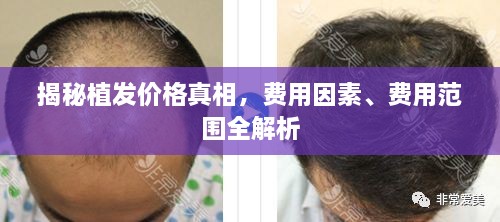 揭秘植發(fā)價格真相，費用因素、費用范圍全解析