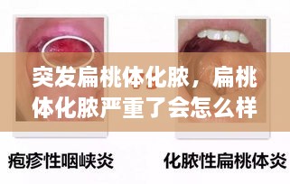突發(fā)扁桃體化膿，扁桃體化膿嚴(yán)重了會(huì)怎么樣了 