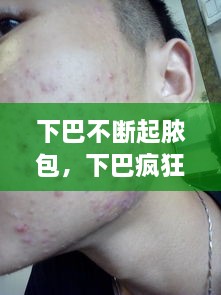 下巴不斷起膿包，下巴瘋狂長(zhǎng)膿包 